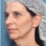 Facelift Before & After Patient #928