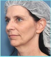 Facelift Before & After Patient #928