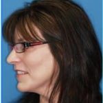 Facelift Before & After Patient #928