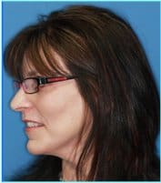 Facelift Before & After Patient #928