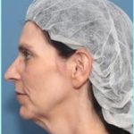 Facelift Before & After Patient #928