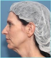 Facelift Before & After Patient #928