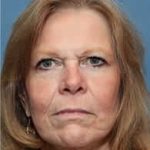 Facelift Before & After Patient #933