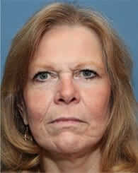Facelift Before & After Patient #933