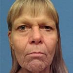 Facelift Before & After Patient #933