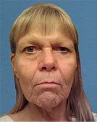 Facelift Before & After Patient #933
