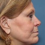 Facelift Before & After Patient #933