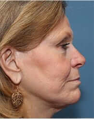 Facelift Before & After Patient #933