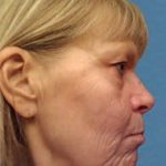 Facelift Before & After Patient #933