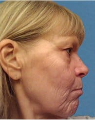 Facelift Before & After Patient #933
