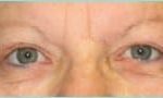 Blepharoplasty Before & After Patient #1280