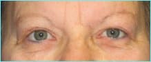 Blepharoplasty Before & After Patient #1280