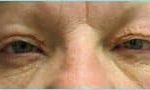 Blepharoplasty Before & After Patient #1280