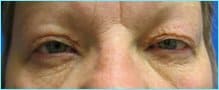 Blepharoplasty Before & After Patient #1280