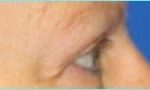 Blepharoplasty Before & After Patient #1280