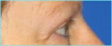 Blepharoplasty Before & After Patient #1280