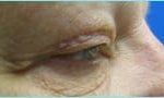 Blepharoplasty Before & After Patient #1280