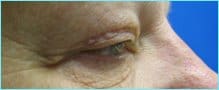 Blepharoplasty Before & After Patient #1280