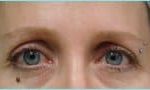 Blepharoplasty Before & After Patient #1243