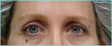 Blepharoplasty Before & After Patient #1243