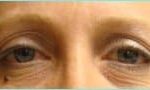 Blepharoplasty Before & After Patient #1243