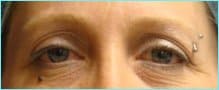 Blepharoplasty Before & After Patient #1243