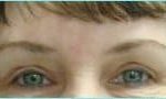 Blepharoplasty Before & After Patient #1272