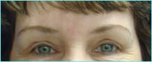 Blepharoplasty Before & After Patient #1272