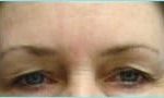 Blepharoplasty Before & After Patient #1272
