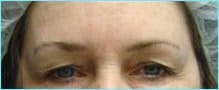 Blepharoplasty Before & After Patient #1272