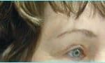 Blepharoplasty Before & After Patient #1272