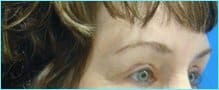 Blepharoplasty Before & After Patient #1272