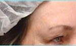 Blepharoplasty Before & After Patient #1272
