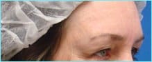 Blepharoplasty Before & After Patient #1272