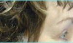 Blepharoplasty Before & After Patient #1272