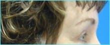 Blepharoplasty Before & After Patient #1272
