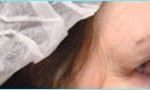 Blepharoplasty Before & After Patient #1272