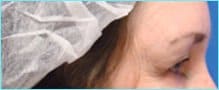 Blepharoplasty Before & After Patient #1272