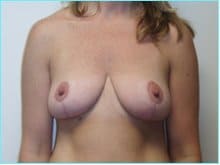 Mastopexy (Breast Lift) Before & After Patient #738