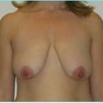 Mastopexy (Breast Lift) Before & After Patient #738