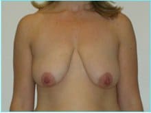 Mastopexy (Breast Lift) Before & After Patient #738