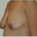 Mastopexy (Breast Lift) Before & After Patient #738