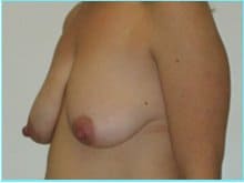 Mastopexy (Breast Lift) Before & After Patient #738