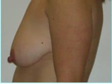 Mastopexy (Breast Lift) Before & After Patient #738