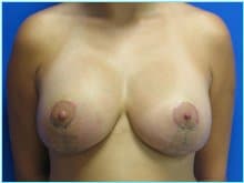 Breast Augmentation Revision (Breast Enlargement Repair) Before & After Patient #640