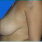 Breast Augmentation Revision (Breast Enlargement Repair) Before & After Patient #640