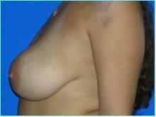 Breast Augmentation Revision (Breast Enlargement Repair) Before & After Patient #640