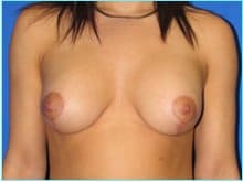 Mastopexy (Breast Lift) Before & After Patient #724
