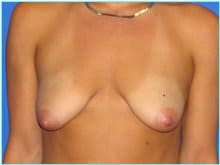 Mastopexy (Breast Lift) Before & After Patient #724