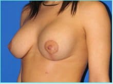 Mastopexy (Breast Lift) Before & After Patient #724